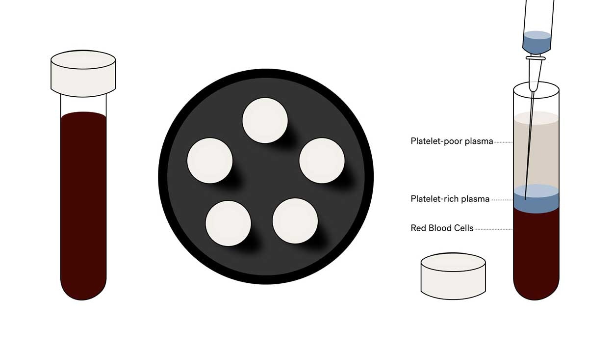 Expert-led Plasma Injections in NY & DC | Ever/Body